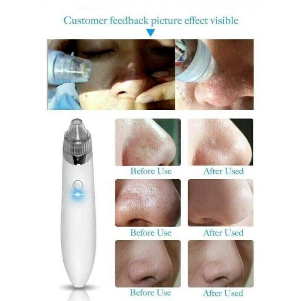 Aorlis Rechargeable Blackhead Aspirator Facial Cleaning
